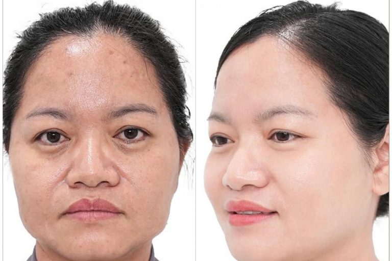 Botox xóa nhăn Chị Như Quỳnh - 42 tuổi - TP. Bắc Ninh, Bắc Ninh