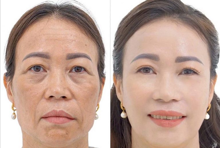 PEEL căng bóng trắng sáng HYDRAGLOW Chị Thùy Vi - 48 tuổi - Thanh Xuân Hà Nội