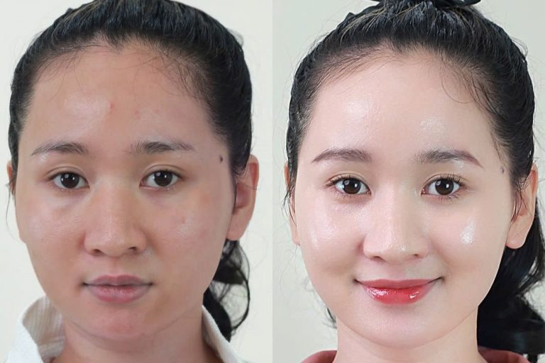 Trẻ hóa BAP Chị Ngọc Anh - 27 tuổi - TP. Việt Trì, Phú Thọ