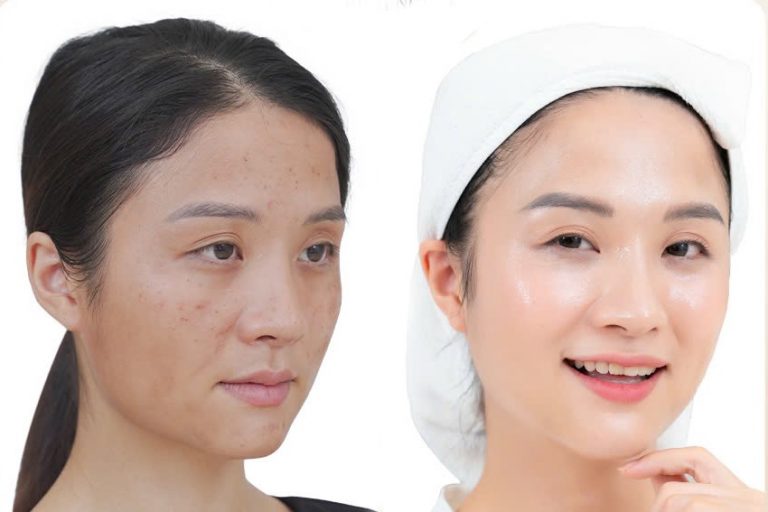 Botox thon hàm Chị Phạm Hương - 29 tuổi - TP. Việt Trì, Phú Thọ